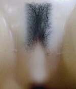 images, pubic hair implant
